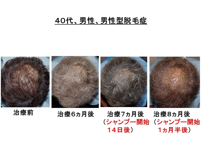 円形脱毛症　病院